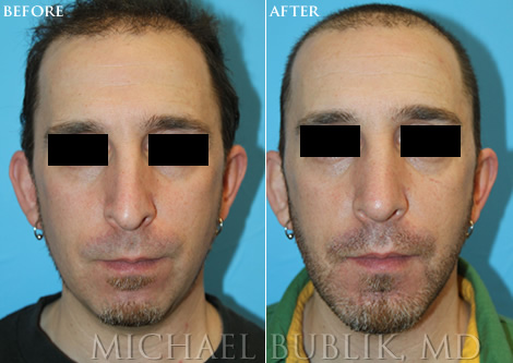 Male Chin Augmentation image front