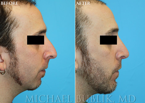 Male Chin Augmentation image right side view