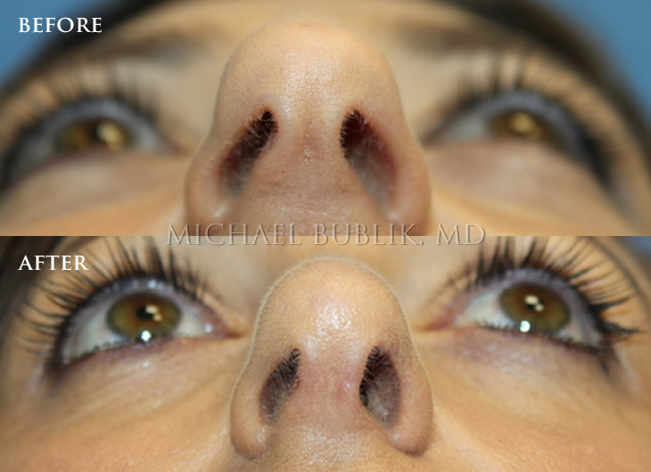 Rhinoplasty Nose Job