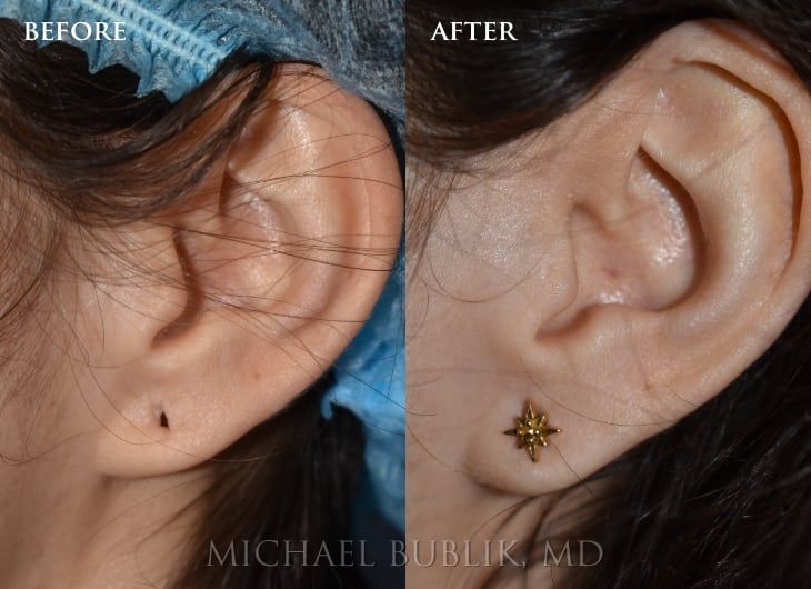 Ear Lobe Repair