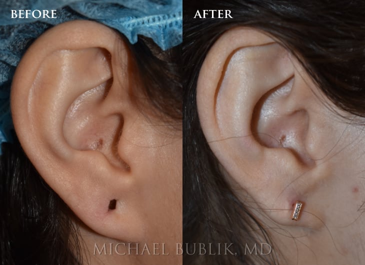In Office Ear Lobe Repair Surgeon Los Angeles, Beverly Hills