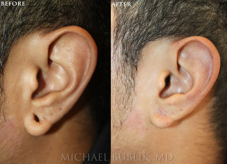 EarLobe Repair by Dr. Michael Bublik