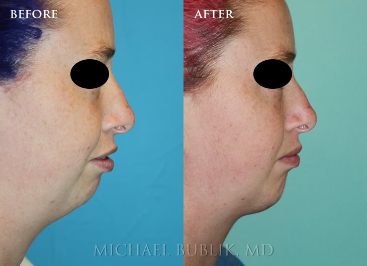 Facelift Liposuction Before and after