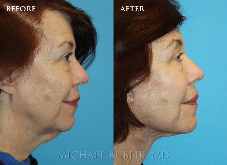 Facelift Before and after