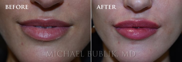 Lip Enhancement with Restylane