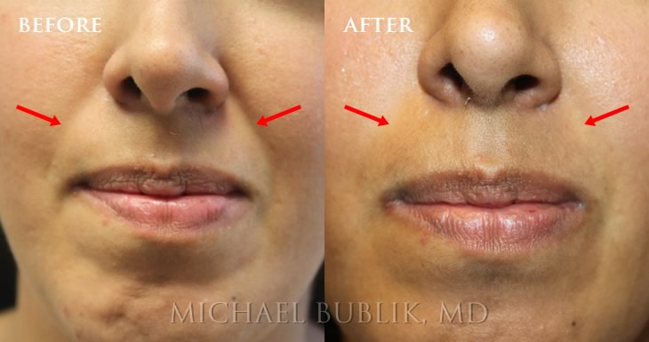 Facial Filler Nasolabial Folds by Dr Michael Bublik 