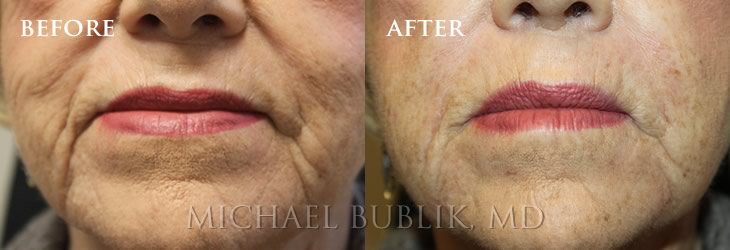 Facial Filler by Dr Michael Bublik 