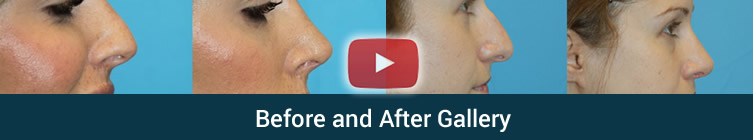 Rhinoplasty Glendale California Before and After Photos