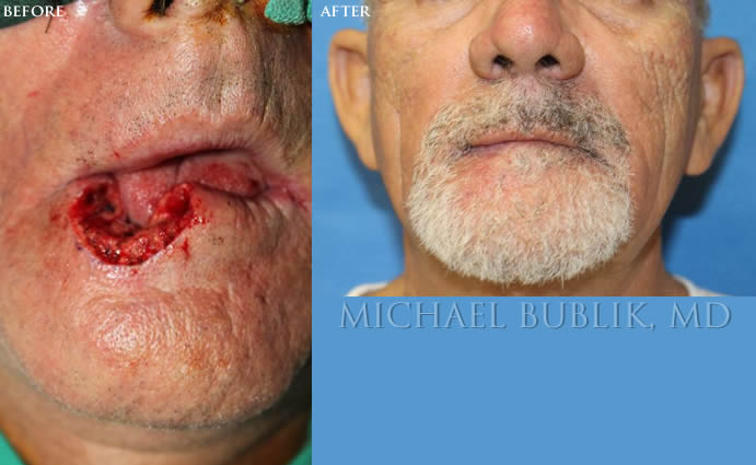Mohs Reconstruction before and after Lower Lip