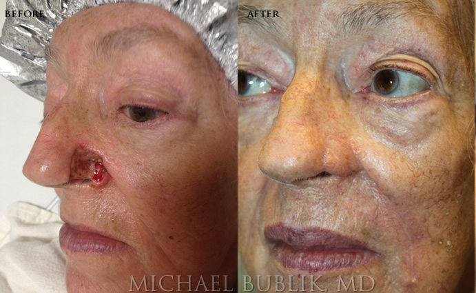 Mohs Reconstruction before and after nose