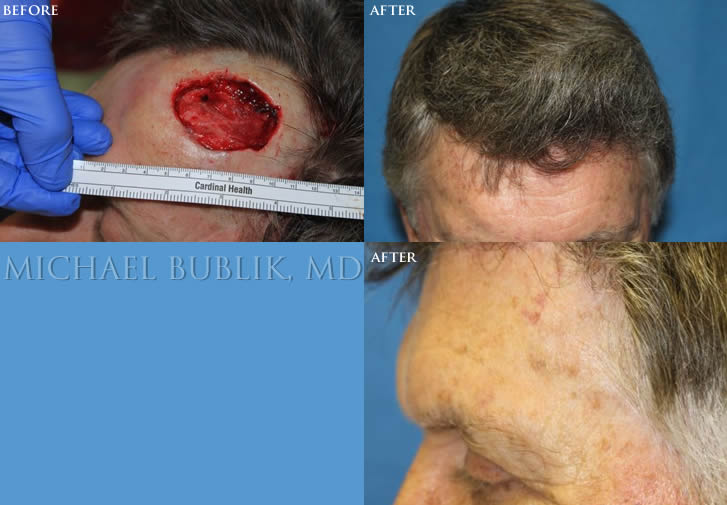 Mohs Reconstruction before and after forehead