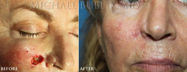 Mohs Reconstruction before and after Cheek