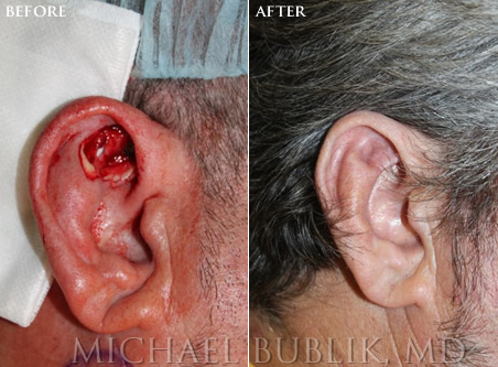 Mohs Reconstruction before and after ear