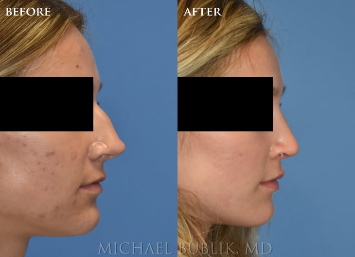 Rhinoplasty before and after by Dr. Michael Bublik Glendale CA
