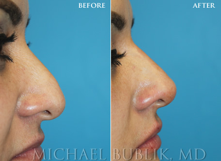 Non Surgical Rhinoplasty by Dr. Michael Bublik