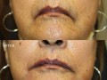 Clinical History:  This middle aged female complained that the corners of her mouth were "droopy."  She had painless correction in the office with Juvaderm Ultra Plus.