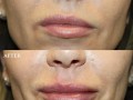 Clinical History: This patient presented with uneven lips and wanted them more symmetric and more plump.  Lip injections are tailored to the type of result a patient desires.  Some patients want plumper lips, some want more symmetry and some just want a small natural enhancement.