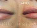 This patient desired a natural "plumping" of her lips