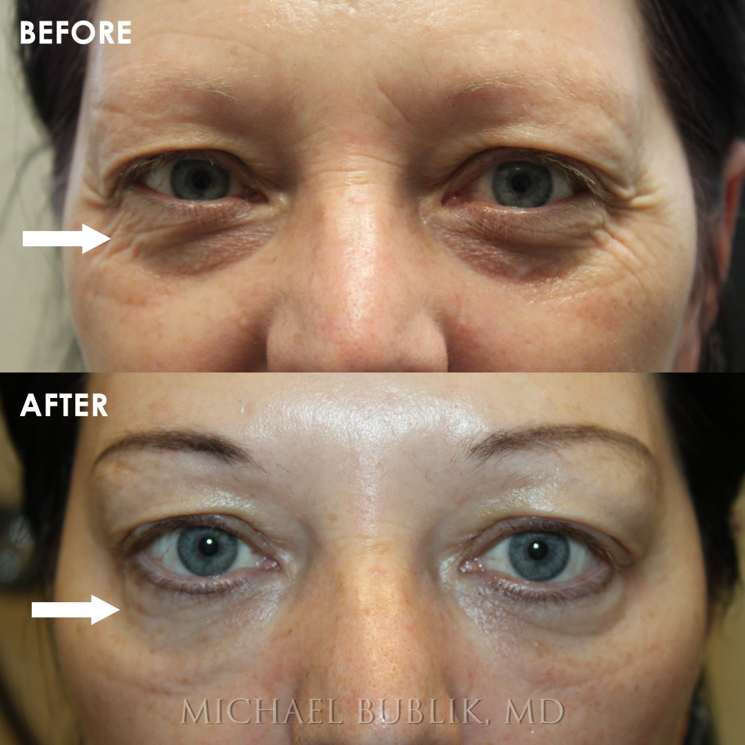 blog-under-eye-filler