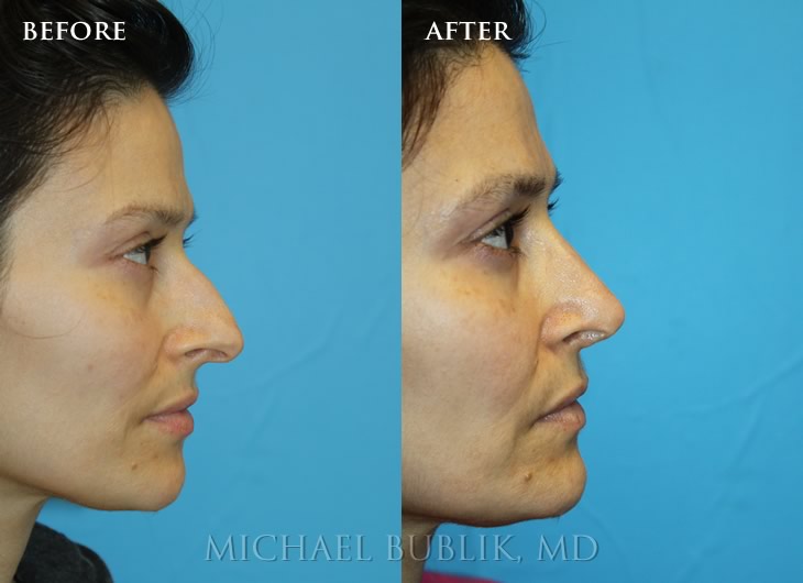 case-study-1-2 Rhinoplasty Surgeon Los Angeles & Glendale