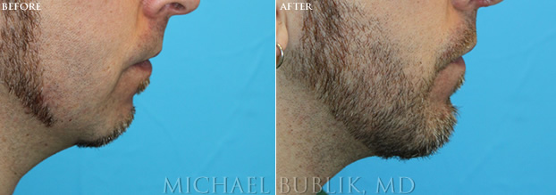 ef-rhino-chin-implant Chin Augmentation - Los Angeles