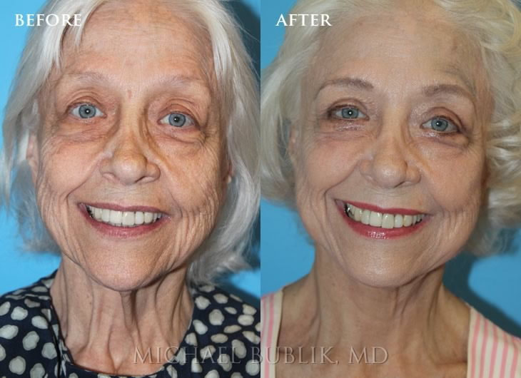 facelift Facelift & Necklift Specialist - Los Angeles