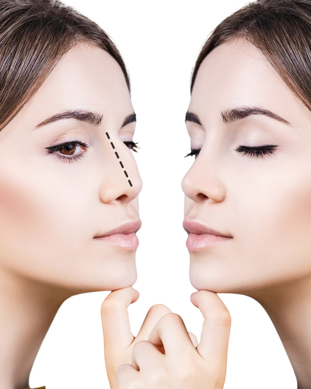 Nose Procedures