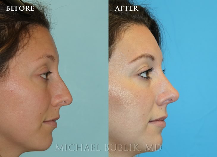 Nose Job Before and After