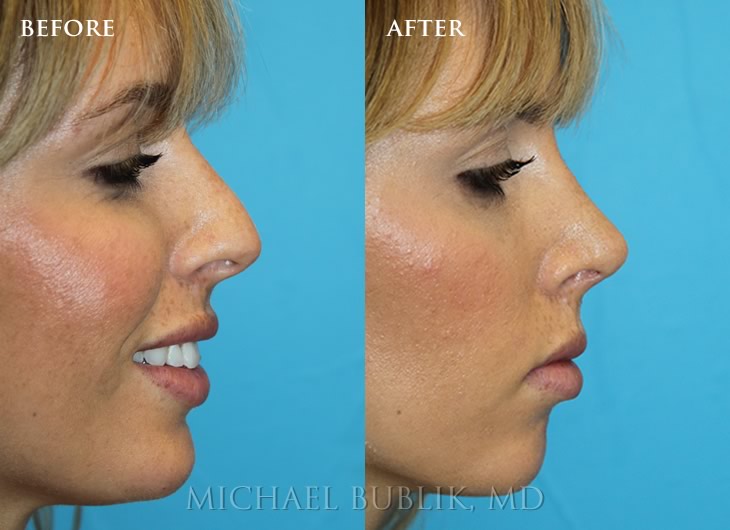 Rhinoplasty Before and After