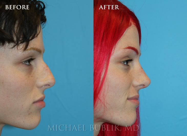 Rhinoplasty by Dr. Bublik