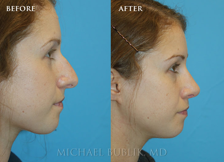 Teenage Rhinoplasty Los Angeles