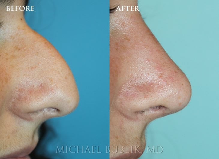 teenage-rhinoplasty-1