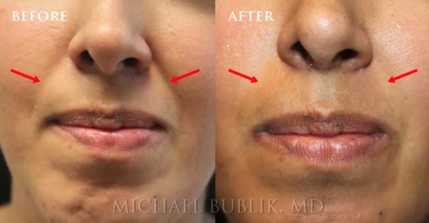 restylane before and after 1 Restylane Los Angeles