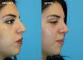 rhinoplasty-2017-2