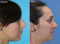 Rhinoplasty preop 10 yr post op