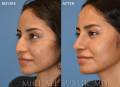rhinoplasty-ec-r-oblique-2021