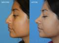 rhinoplasty-2018-3