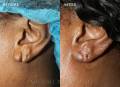 ear-lobe-repair-2017-1