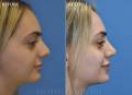 rhinoplasty-LD-left-sdie-2022-1