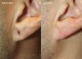 earlobe-repair-2018-1