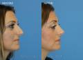 rhinoplasty-lateral-2019-3