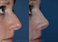rhinoplasty-BH-close-2022-1