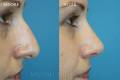 rhinoplasty-2017-6