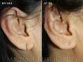 earlobe-repair-6