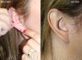 ear-lobe-repair1