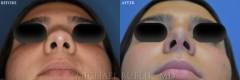rhinoplasty-GP-base2