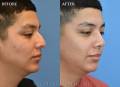 ep-rhinoplasty-oblique-2021