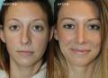 rhinoplasty-2017-1