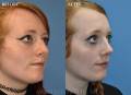 rhinoplasty-oblique-side-2022-4