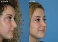 rhinoplasty-dec-2018-oblique